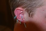 Akupunktur der Ohren